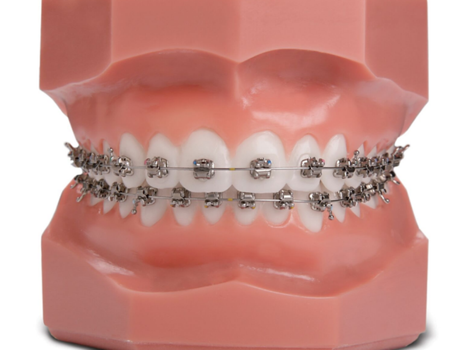 Self ligating braces Self ligating braces