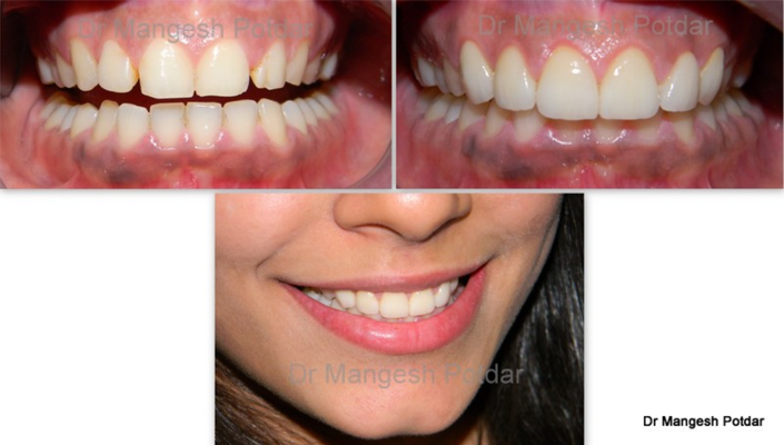 Smile Design Smile Design