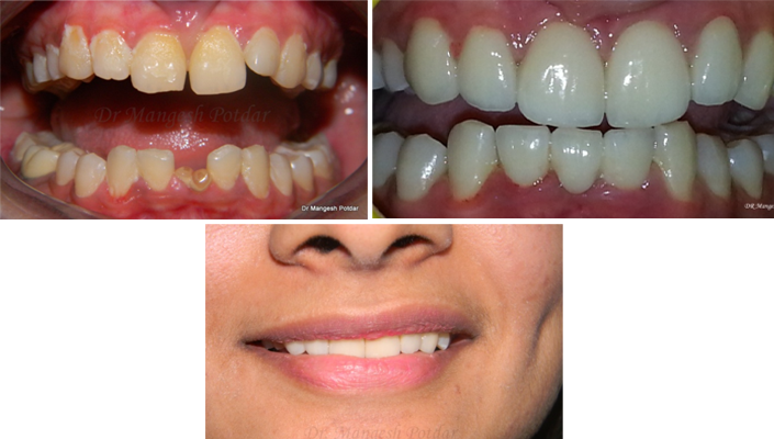 Smile Design Smile Design