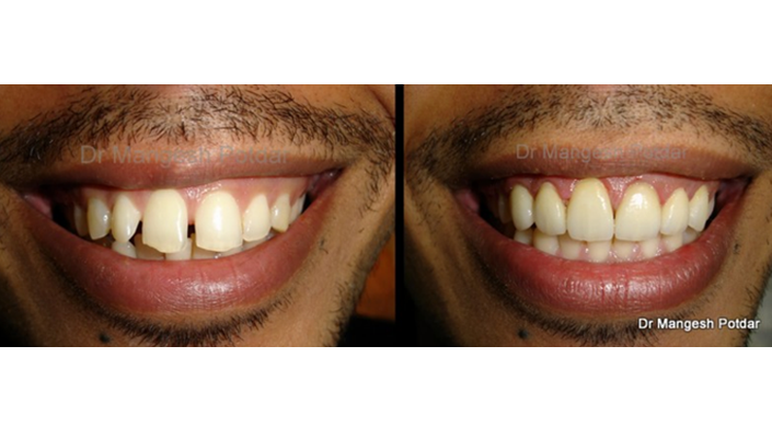 Smile Design Smile Design