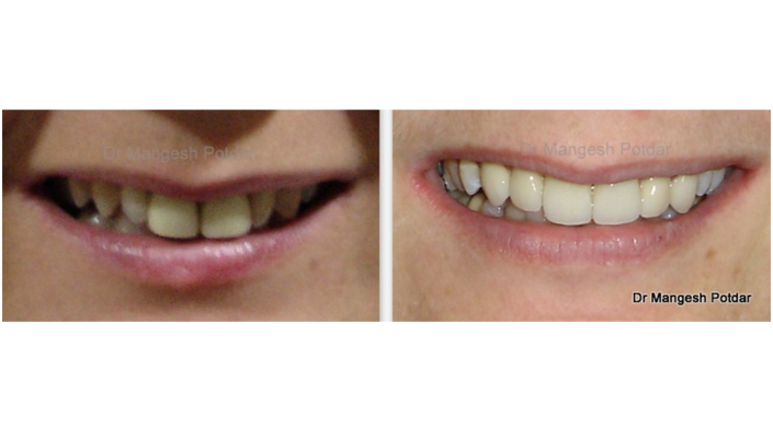 Smile Design Smile Design