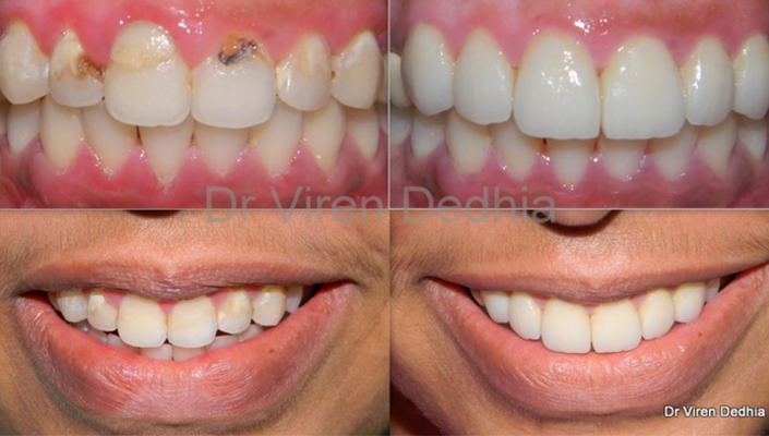 Smile Design Smile Design