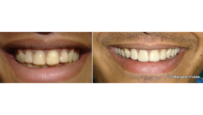 Smile Design Smile Design