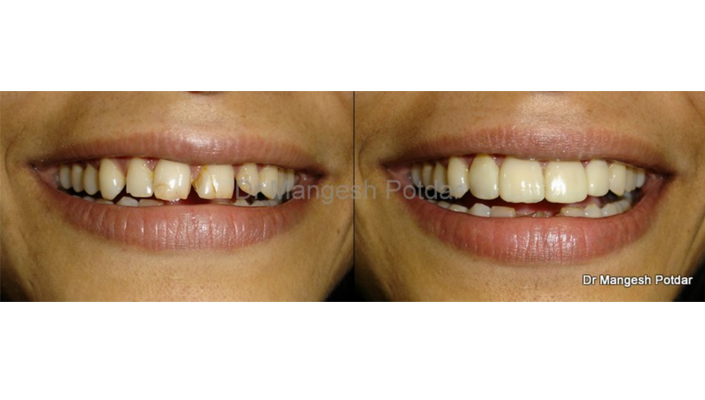 Smile Design Smile Design
