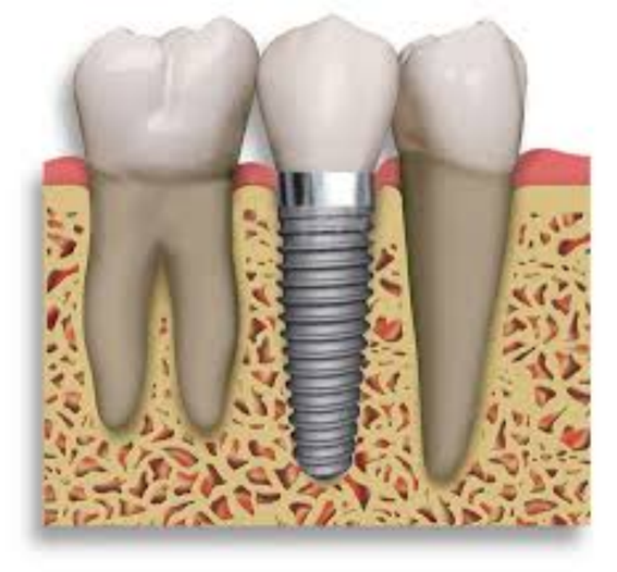 Implant Dentistry Implant Dentistry