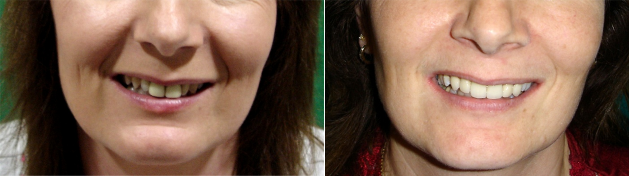 Full mouth rehabilitation Full mouth rehabilitation