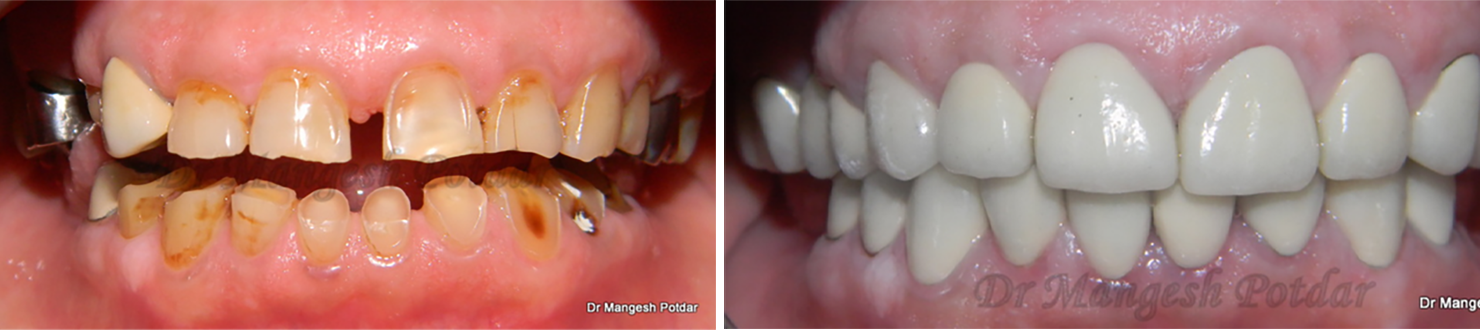 Full mouth rehabilitation Full mouth rehabilitation