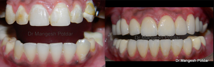 Full mouth rehabilitation Full mouth rehabilitation