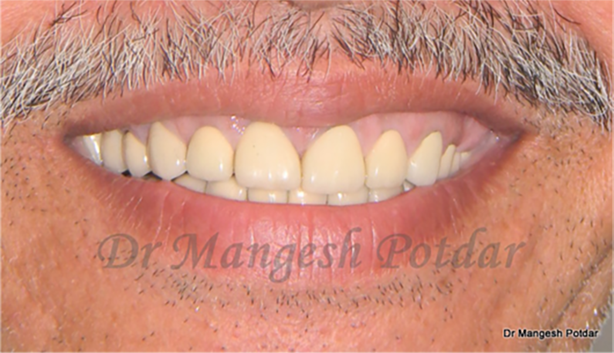 Full mouth rehabilitation Full mouth rehabilitation