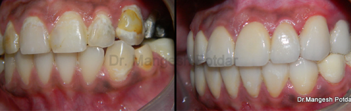 Full mouth rehabilitation Full mouth rehabilitation