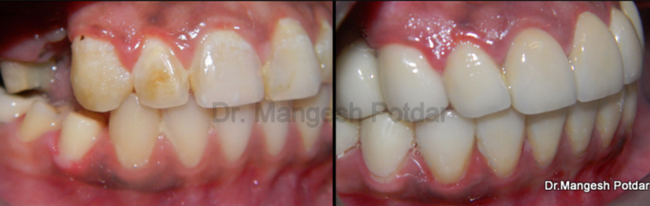 Full mouth rehabilitation Full mouth rehabilitation