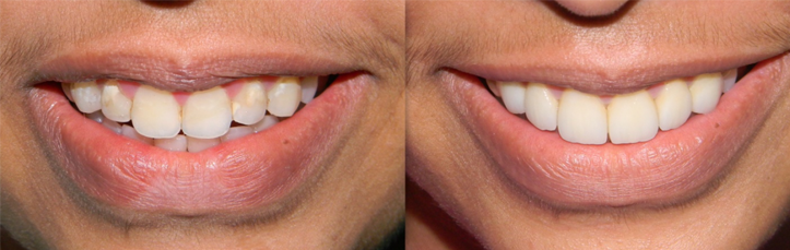 Full mouth rehabilitation Full mouth rehabilitation