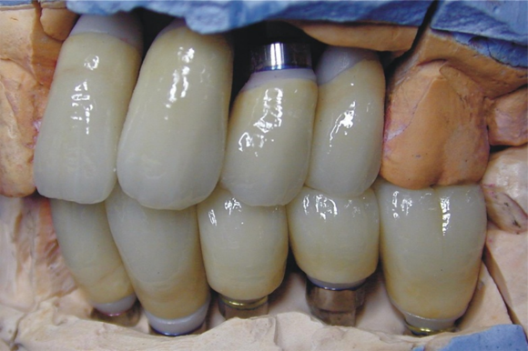 Implant Dentistry