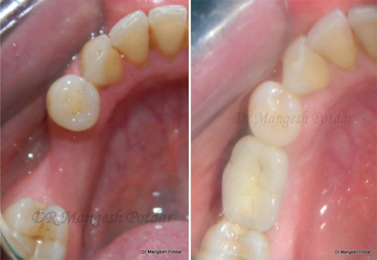 Implant Dentistry