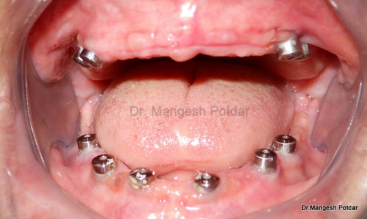 Implant Dentistry Implant Dentistry