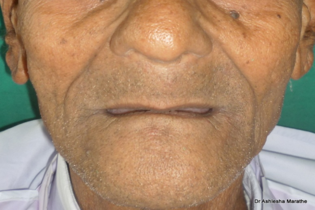 Dentures teeth-before