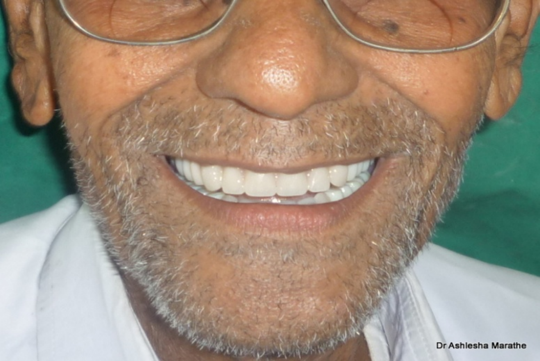 Dentures teeth-after