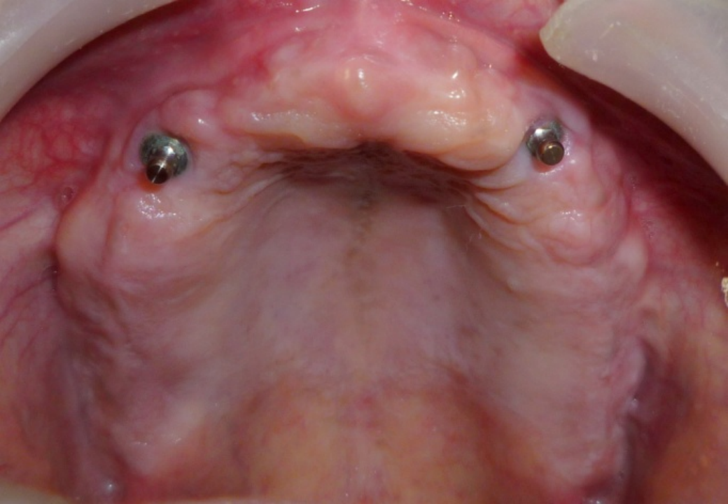 Dentures teeth-before