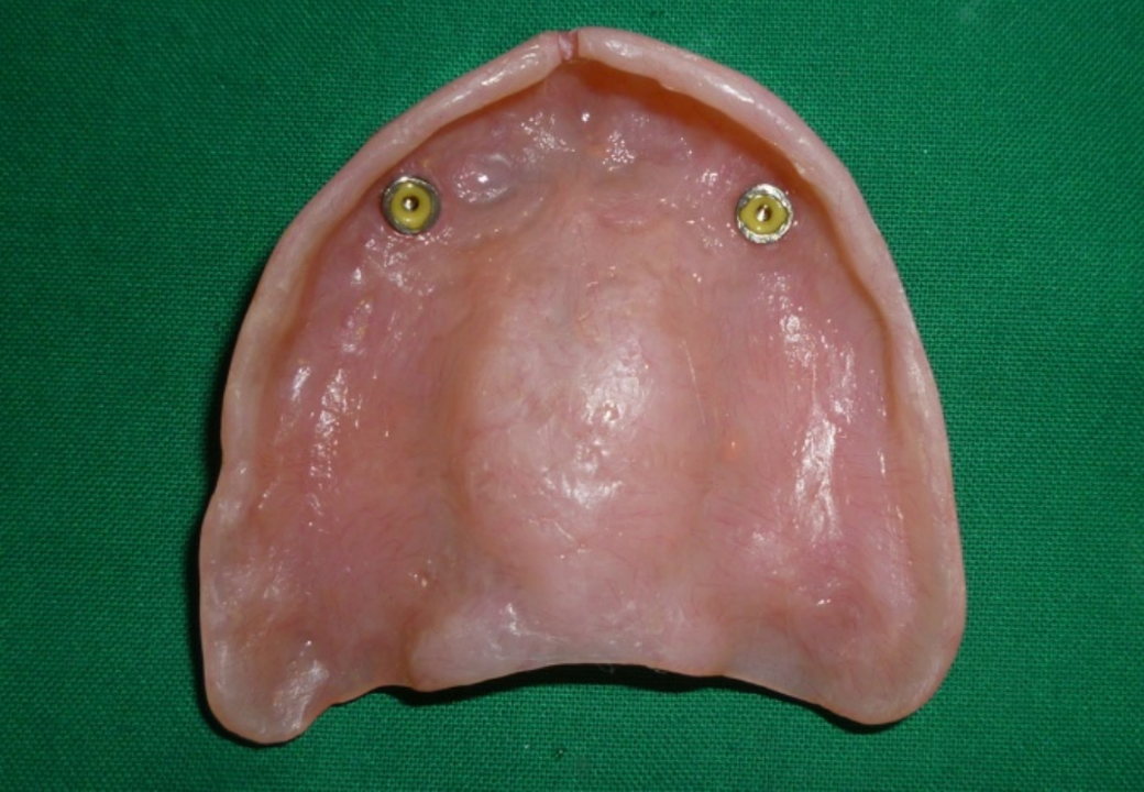 Dentures teeth-after