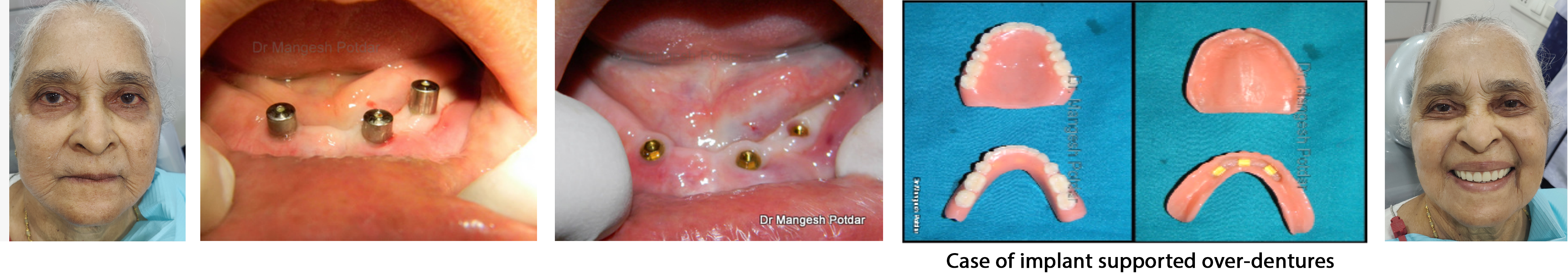 Implant Dentistry Implant Dentistry